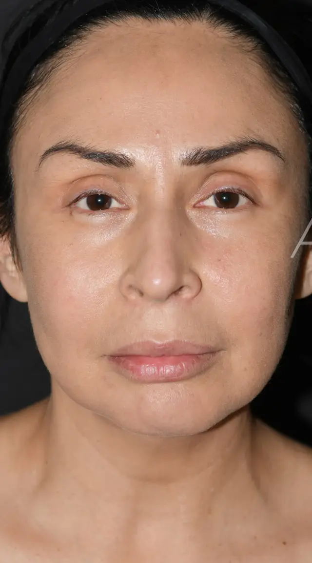 Facelift before at Aesthetx in Campbell, CA