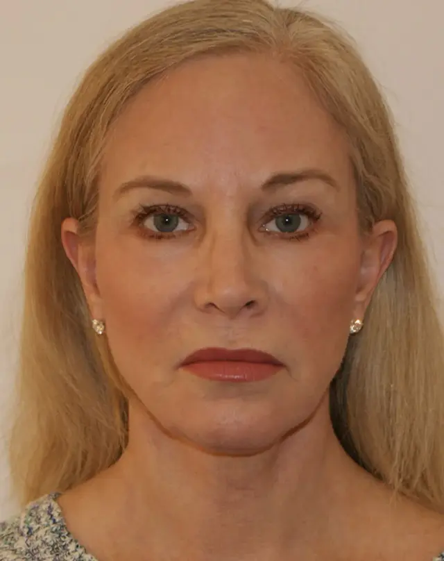 Facelift after at Aesthetx in Campbell, CA