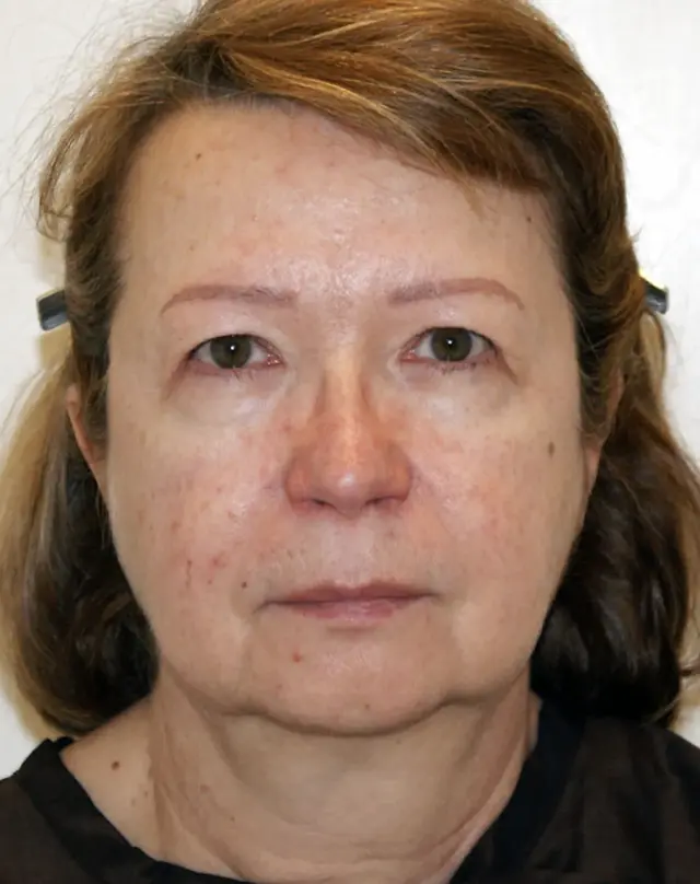 Facelift before at Aesthetx in Campbell, CA