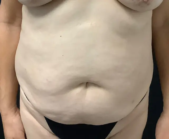 Tummy Tuck before at Aesthetx in Campbell, CA