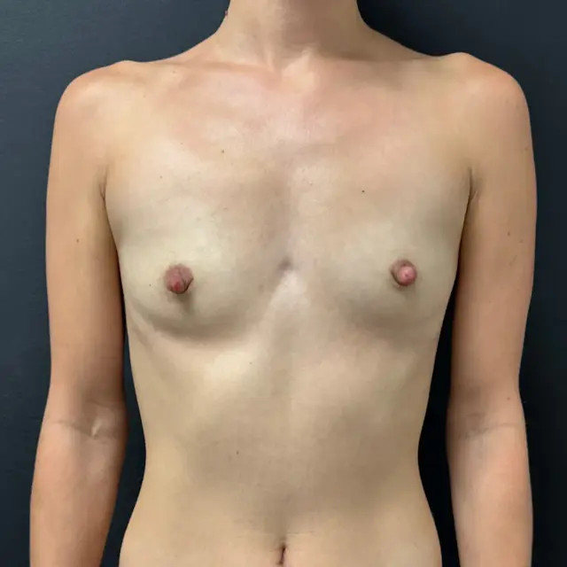 Breast Augmentation before at Aesthetx in Campbell, CA