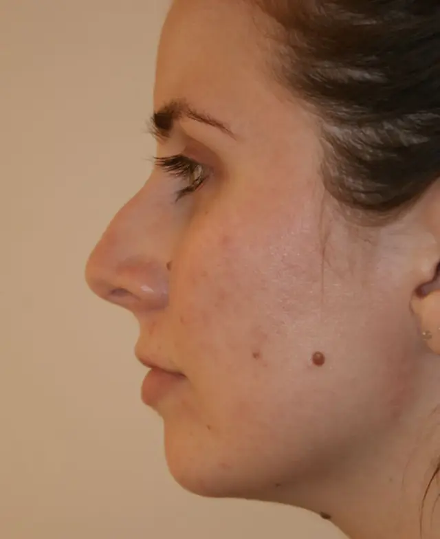 Rhinoplasty before at Aesthetx in Campbell, CA