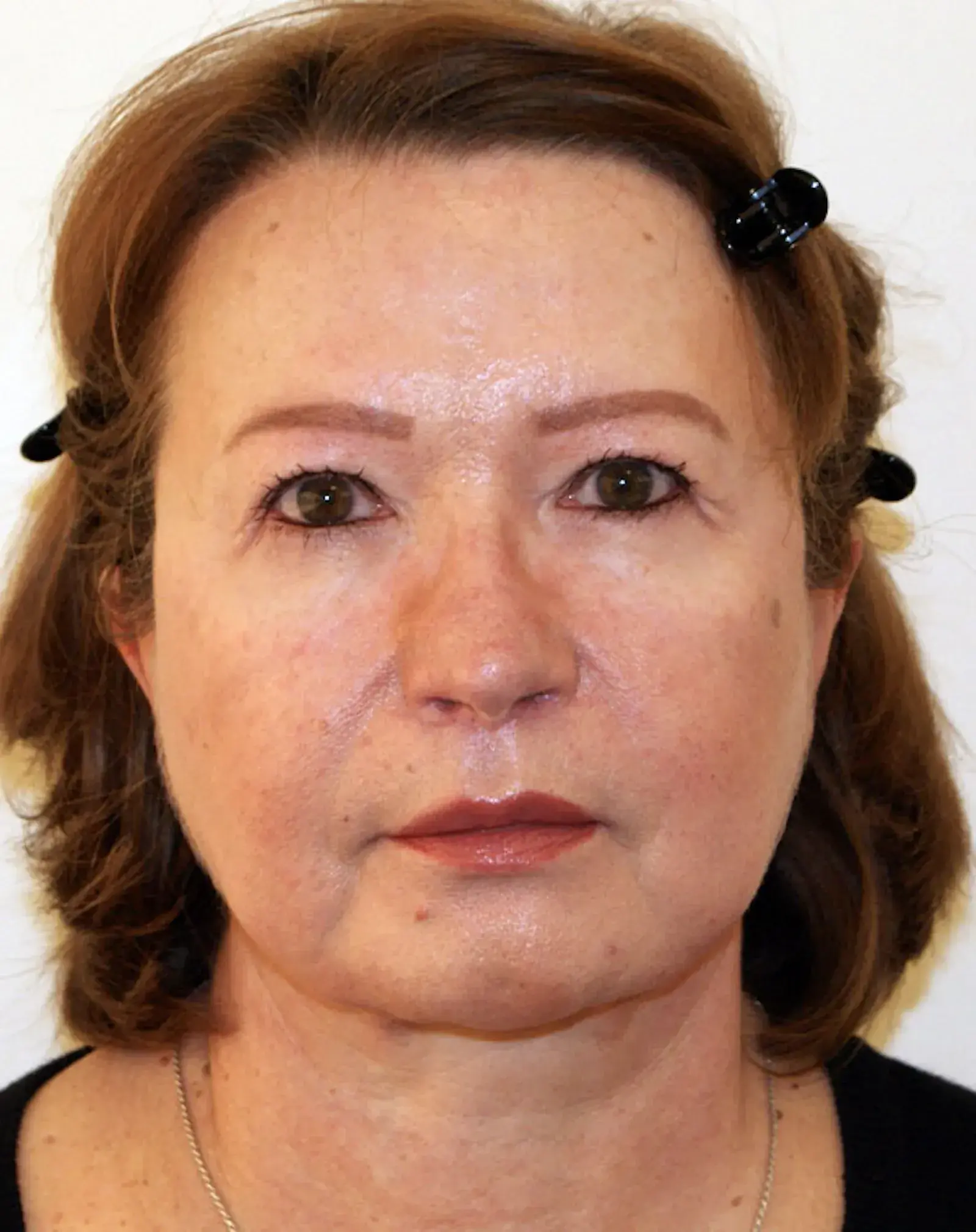 Aesthetx facelift after — Campbell, CA