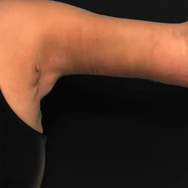 Arm Lift after at Aesthetx in Campbell, CA