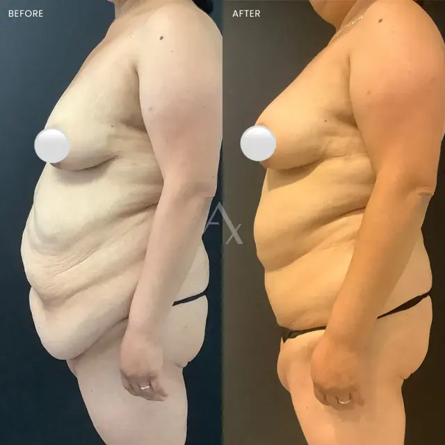 Tummy Tuck result at Aesthetx in Campbell, CA