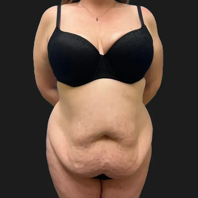 Tummy Tuck before at Aesthetx in Campbell, CA