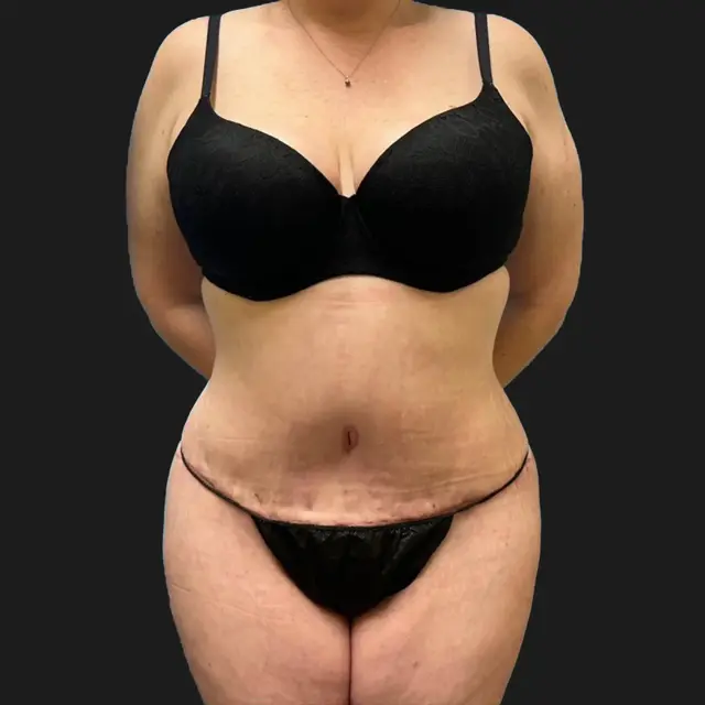 Tummy Tuck after at Aesthetx in Campbell, CA