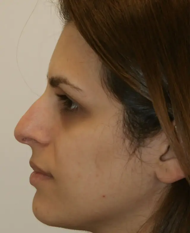 Rhinoplasty before at Aesthetx in Campbell, CA