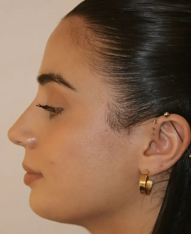 Rhinoplasty after at Aesthetx in Campbell, CA