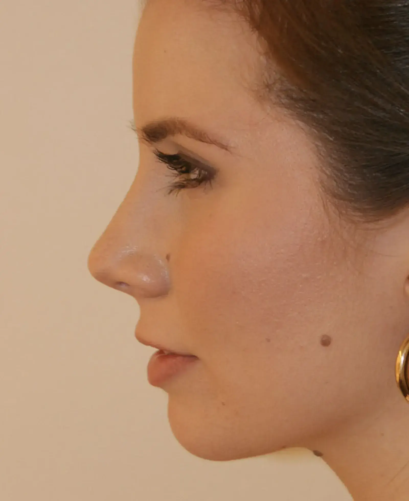 Aesthetx rhinoplasty after — Campbell, CA