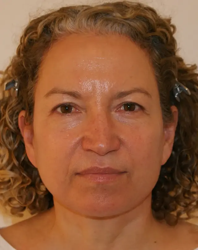 Facelift after at Aesthetx in Campbell, CA