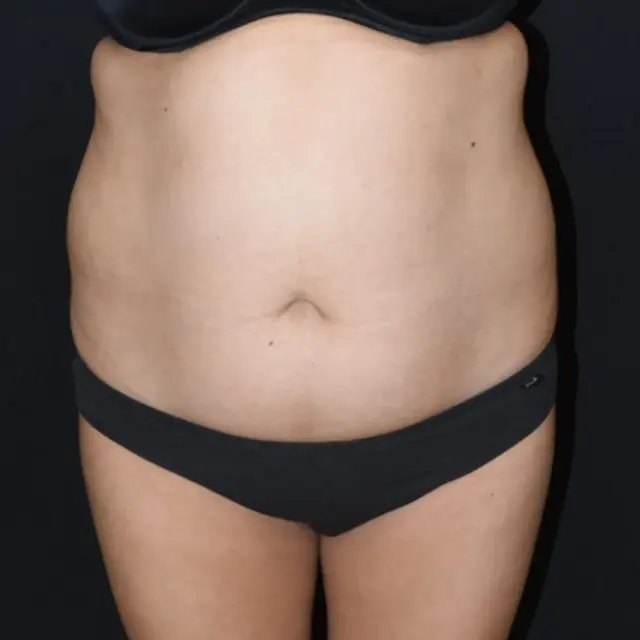 Tummy Tuck before at Aesthetx in Campbell, CA
