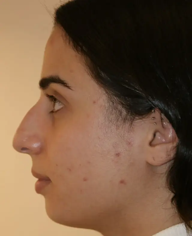 Rhinoplasty before at Aesthetx in Campbell, CA