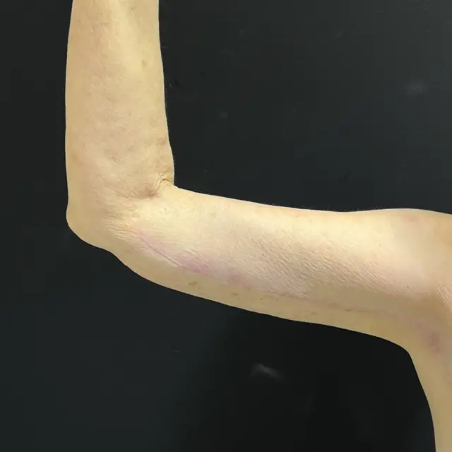 Arm Lift after at Aesthetx in Campbell, CA