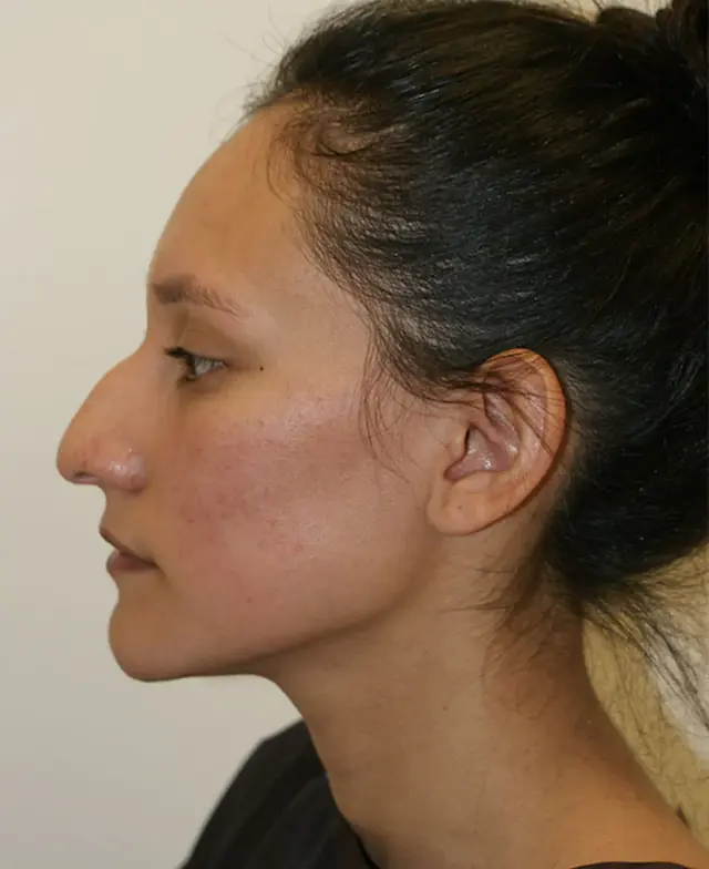 Rhinoplasty before at Aesthetx in Campbell, CA