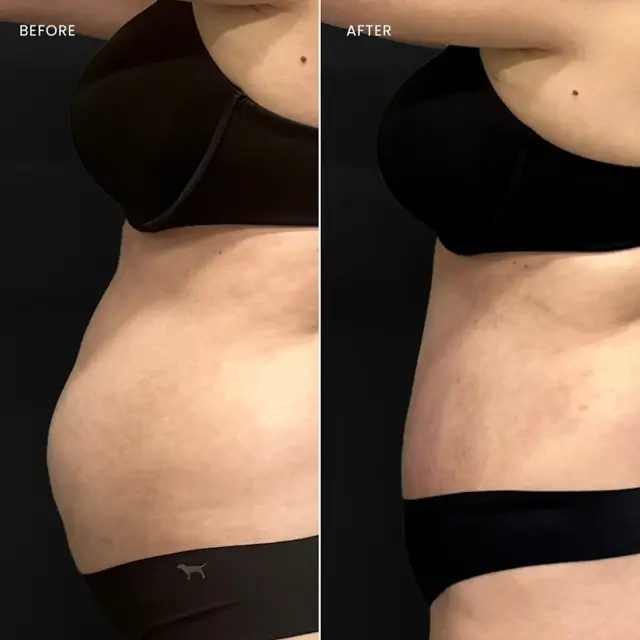 Tummy Tuck result at Aesthetx in Campbell, CA