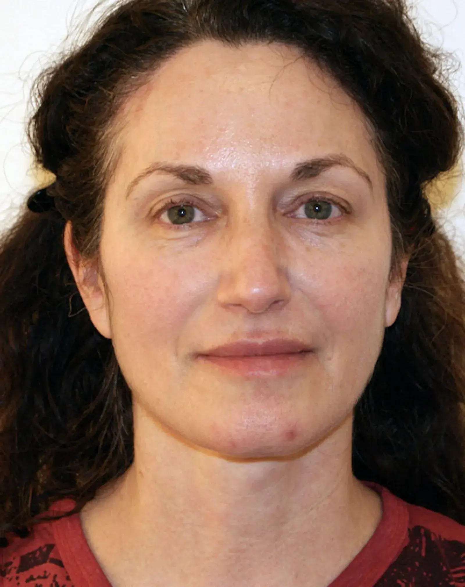 Aesthetx facelift after — Campbell, CA