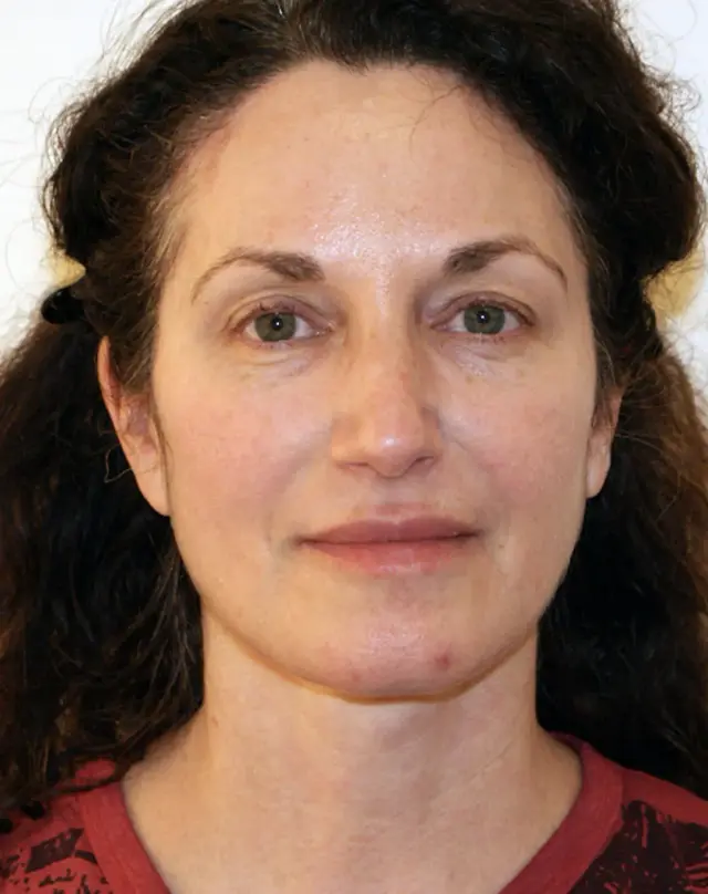 Facelift after at Aesthetx in Campbell, CA