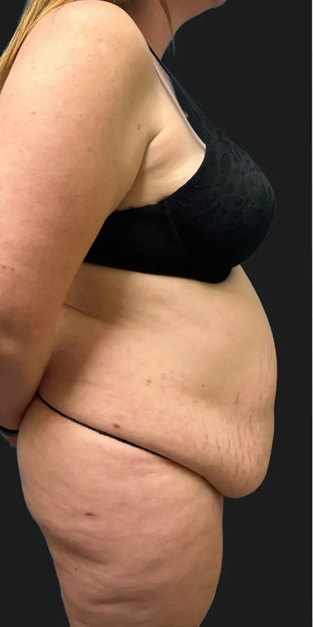 Tummy Tuck before at Aesthetx in Campbell, CA
