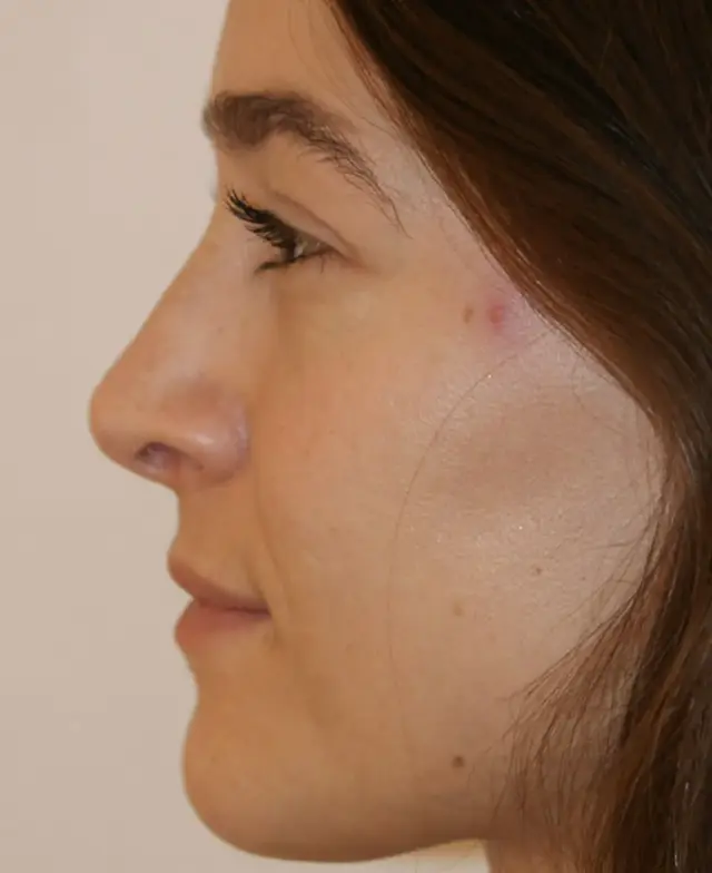 Rhinoplasty after at Aesthetx in Campbell, CA