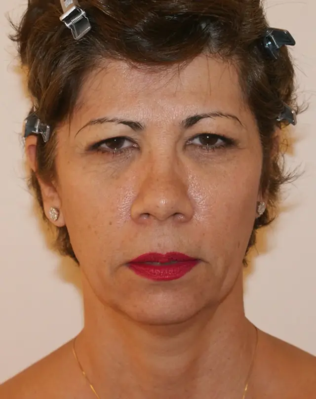 Facelift before at Aesthetx in Campbell, CA