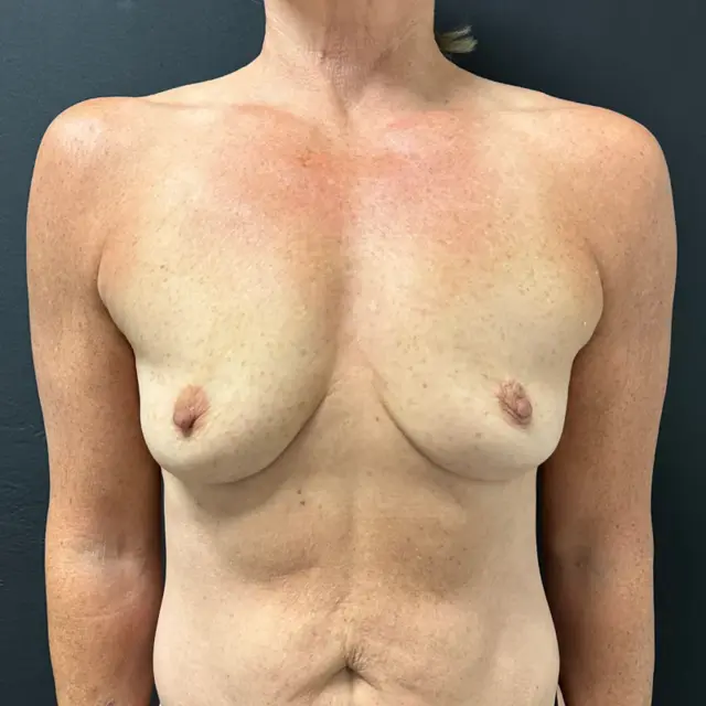 Breast Augmentation before at Aesthetx in Campbell, CA