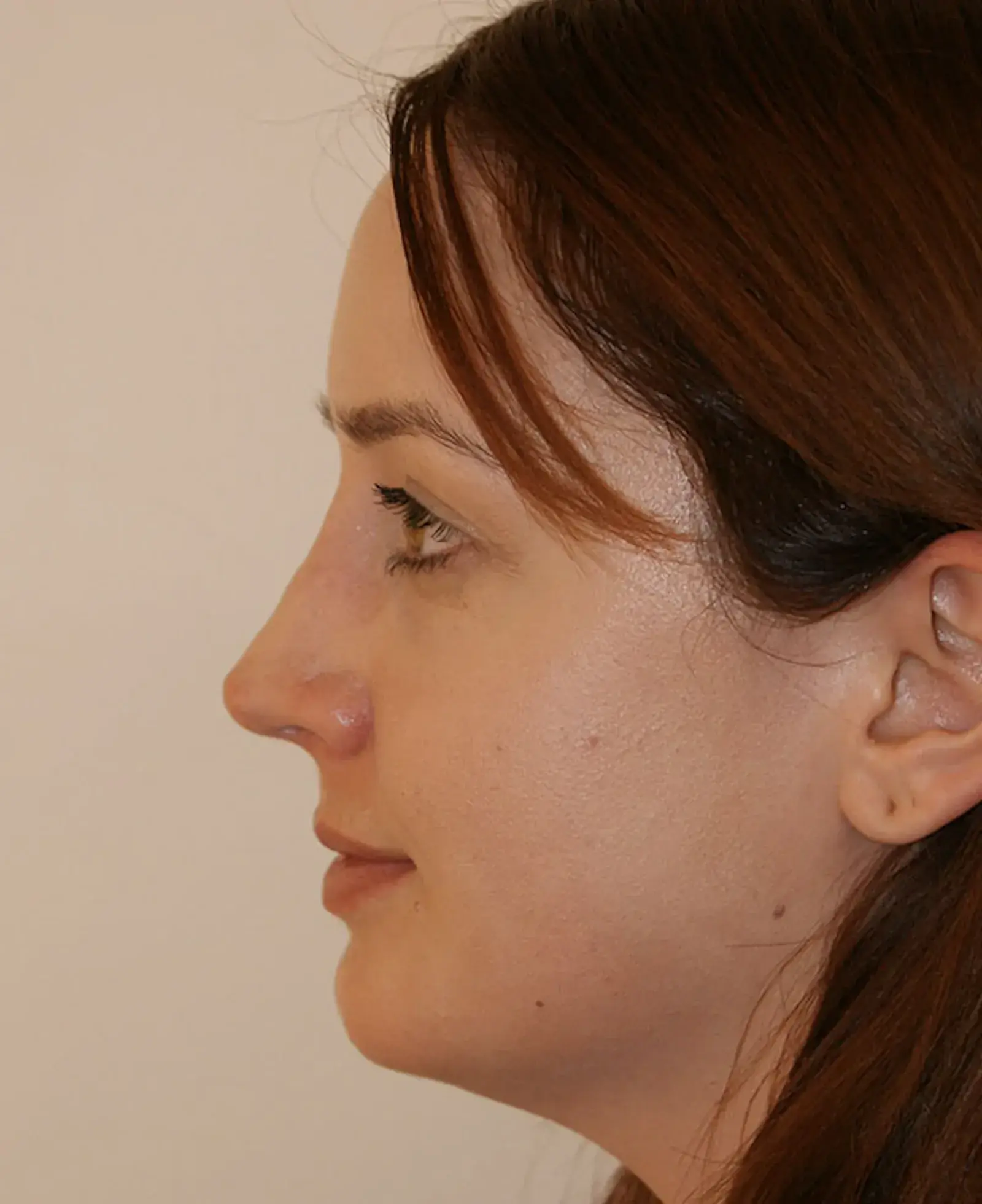Aesthetx rhinoplasty after — Campbell, CA