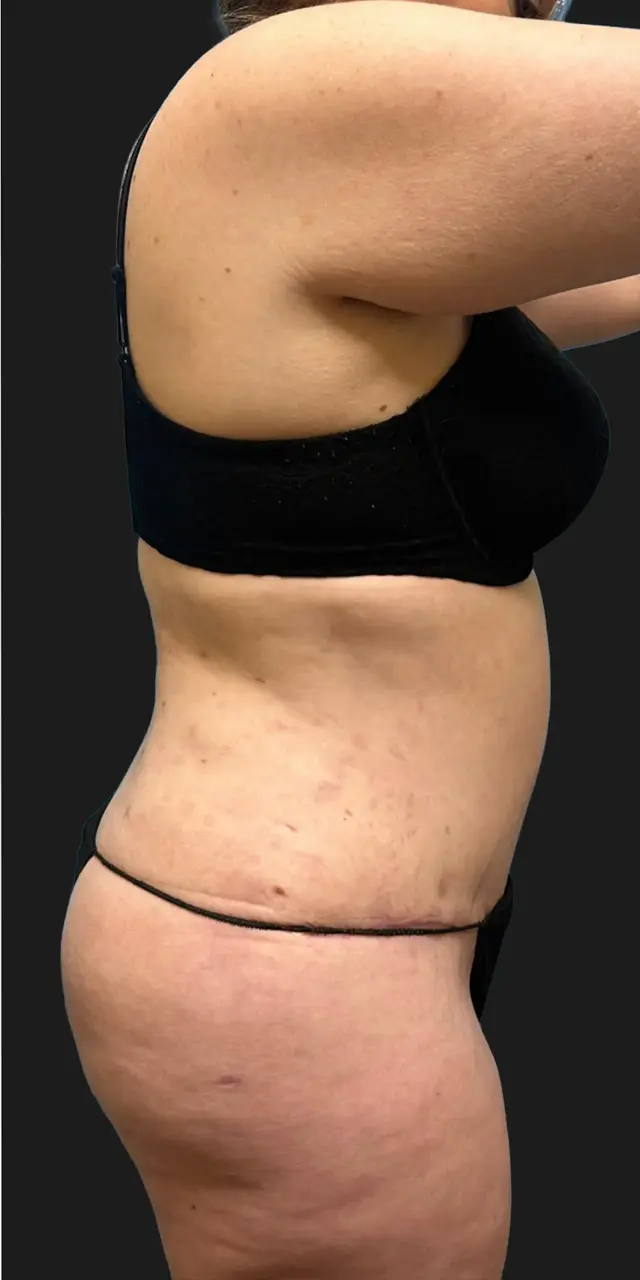 Tummy Tuck after at Aesthetx in Campbell, CA