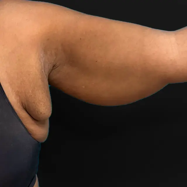 Arm Lift before at Aesthetx in Campbell, CA
