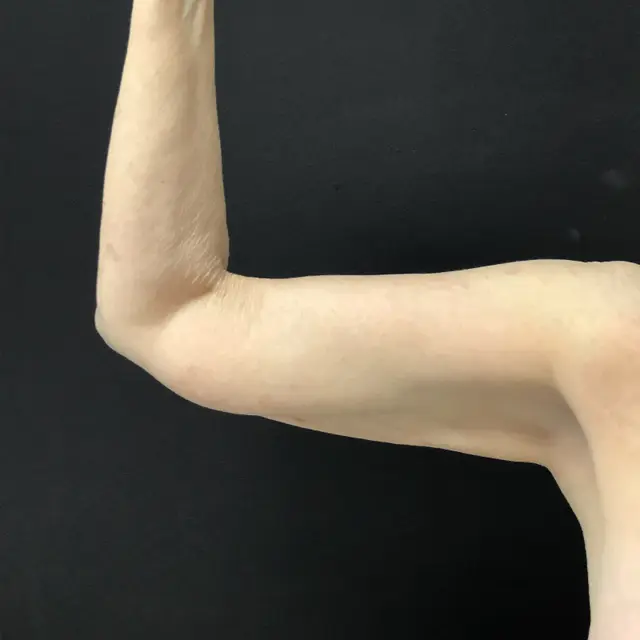 Arm Lift before at Aesthetx in Campbell, CA