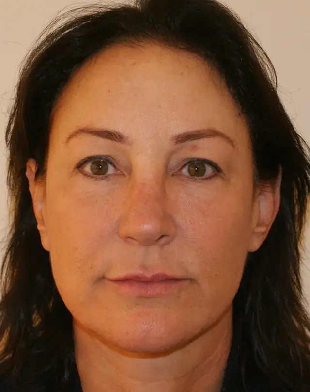 Facelift after at Aesthetx in Campbell, CA