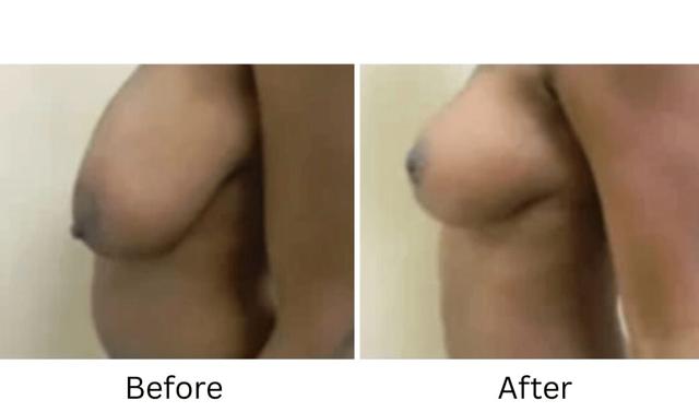 Breast Reduction result at Image Cosmetic Surgery Center in Acworth, GA