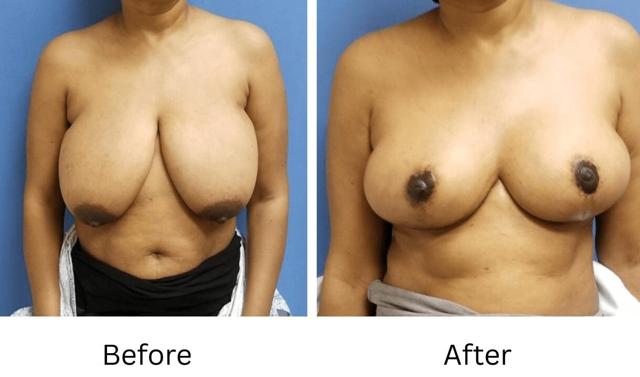 Breast Reduction result at Image Cosmetic Surgery Center in Acworth, GA