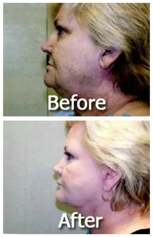 Neck Lift result at Image Cosmetic Surgery Center in Acworth, GA