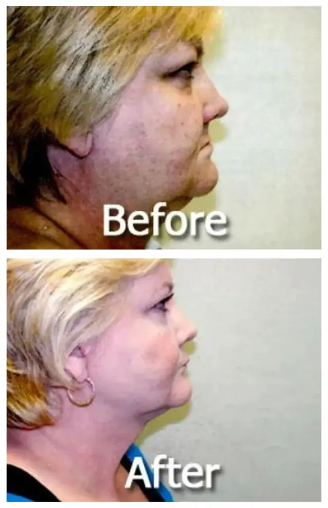 Neck Lift result at Image Cosmetic Surgery Center in Acworth, GA