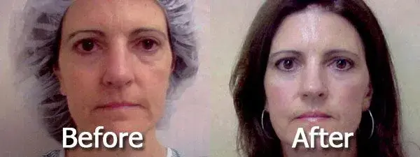 Image Cosmetic Surgery Center result — Acworth, GA
