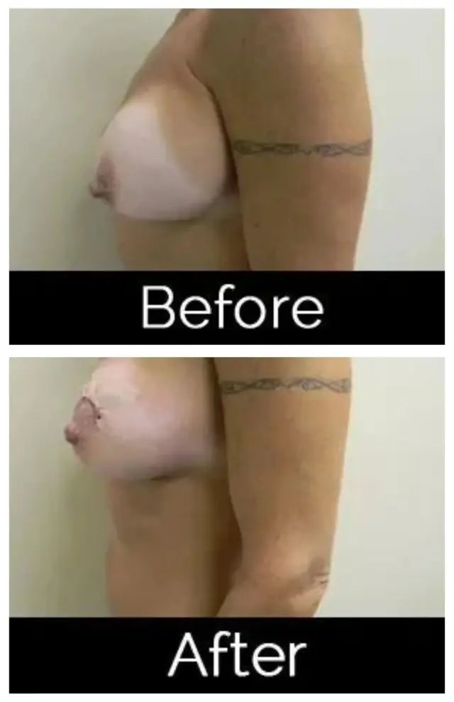 Breast Lift result at Image Cosmetic Surgery Center in Acworth, GA