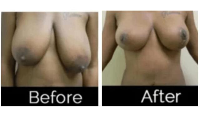 Breast Lift result at Image Cosmetic Surgery Center in Acworth, GA