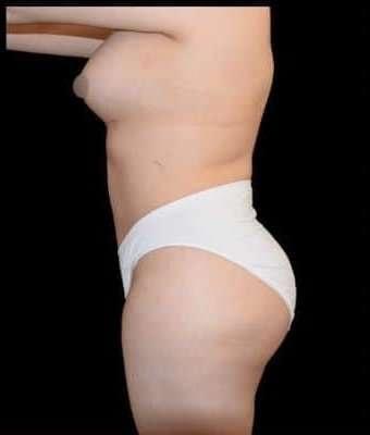 Ali Roham, MD tummy tuck after — Newport Beach, CA