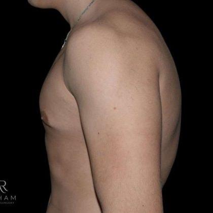 Ali Roham, MD gynecomastia after — Newport Beach, CA