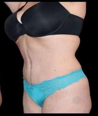 Ali Roham, MD tummy tuck after — Newport Beach, CA