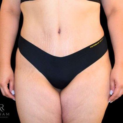 Ali Roham, MD tummy tuck after — Newport Beach, CA