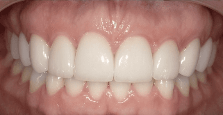 Scottsdale Cosmetic Dentistry smile makeover after — Scottsdale, AZ
