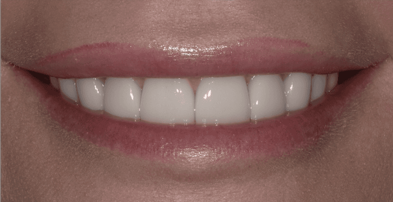 Scottsdale Cosmetic Dentistry smile makeover after — Scottsdale, AZ