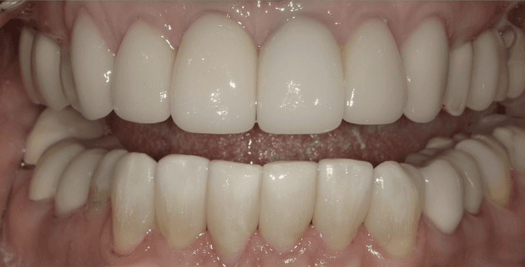 Scottsdale Cosmetic Dentistry smile makeover after — Scottsdale, AZ
