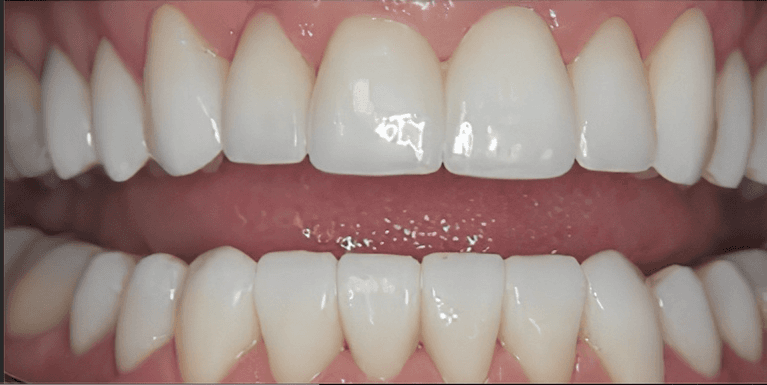 Scottsdale Cosmetic Dentistry smile makeover after — Scottsdale, AZ