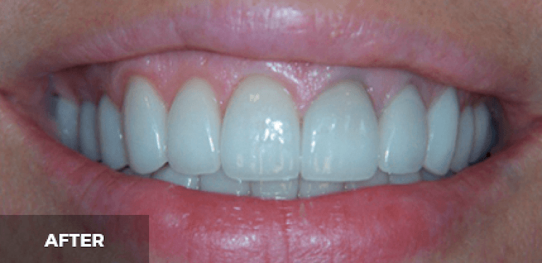Scottsdale Cosmetic Dentistry smile makeover after — Scottsdale, AZ