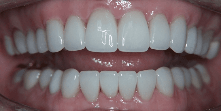 Scottsdale Cosmetic Dentistry smile makeover after — Scottsdale, AZ
