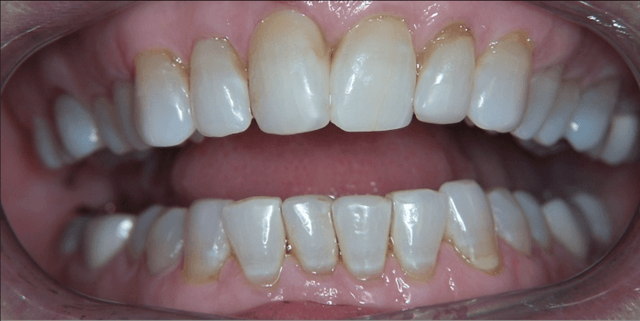 Smile Makeover before at Scottsdale Cosmetic Dentistry in Scottsdale, AZ
