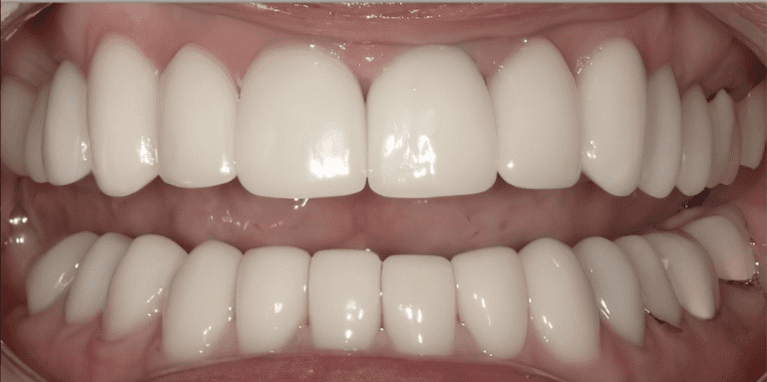 Scottsdale Cosmetic Dentistry smile makeover after — Scottsdale, AZ